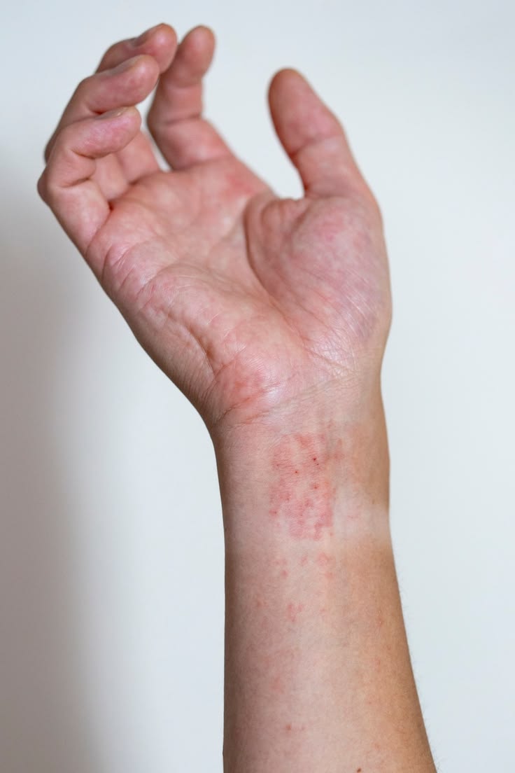 Mano y muñeca mostrando síntomas de piel atópica